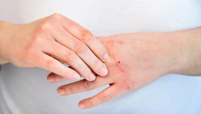 Yetersiz Protein Tüketimi: Belirtiler ve Çözüm Yolları